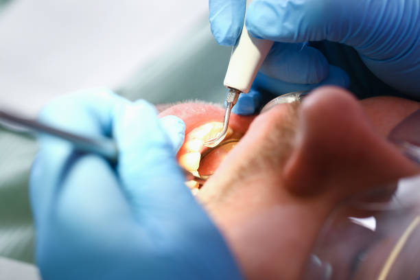 Best Emergency Wisdom Tooth Extraction in Wallington, NJ
